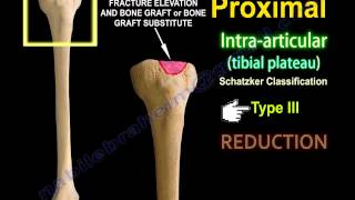 Tibial Plateau Fracture Fixation Proximal Tibia  Everything You Need To Know  Dr Nabil Ebraheim [upl. by Yaluz]