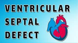 Ventricular Septal Defect [upl. by Atiugal370]