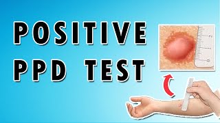 Positive PPD Test [upl. by Mcmurry523]