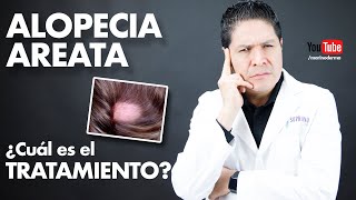 Alopecia areataTratamiento  Dr Marino dermatólogo [upl. by Rihsab]