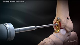 Minimally Invasive Ankle Fusion [upl. by Cormier]