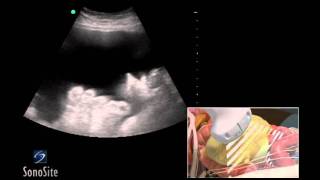 Chorionic Villus Explained A Quick Recap in Embryology [upl. by Leummas]