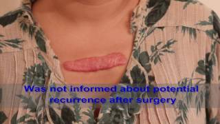 Chest Keloids  Mistakes to Avoid [upl. by Mae]