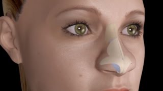 How to Apply a Who Nose Prosthetic [upl. by Franckot]