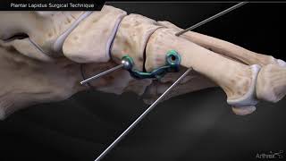 Plantar Lapidus Surgical Technique [upl. by Iggem738]