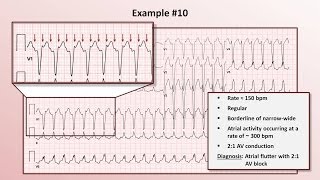 Cardiac cycle 5 Atrial diastole ventricular systole [upl. by Collar]