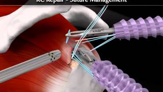 Arthrex RC Repair Suture Management [upl. by Deerc]