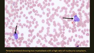 Pediatric Leukemia and lymphoma [upl. by Pomfret]