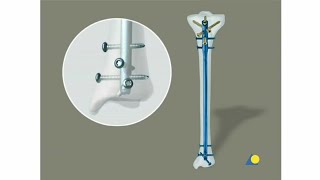 Tibia  Fracture  Intramedullary Nailing with the Expert Tibial Nail With Reaming [upl. by Leugim]