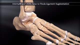 InternalBrace™ ATFL Talus to Fibula Ligament Augmentation [upl. by Ontine906]