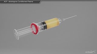 ACP  Autologous Conditioned Plasma [upl. by Noreen]