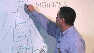 Multiple Myeloma  signs and symptoms pathophysiology treatment [upl. by Herve]