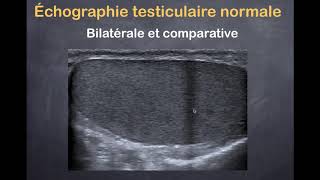 Tumeurs du testicule  1 Imagerie normale [upl. by Airtened]