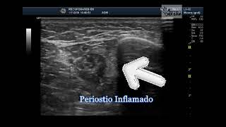 periostitis tibial medial [upl. by Modeste]