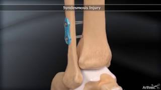 Syndesmosis Injury [upl. by Neelear]