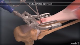 PARS Achilles Jig System [upl. by Mayfield]