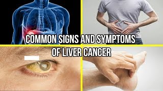 Fatty Liver Symptoms Causes and Treatment  Dr Rahul Rai Prof [upl. by Sharla]