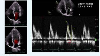 S1 Heart Sound  Learn How to Auscultate Part 8 [upl. by Apollus]