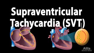 Supraventricular Tachycardia SVT PSVT Animation [upl. by Rentsch]