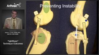 TightRope® Technique Outcomes [upl. by Ahsaeyt]