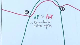 Ventricular Septal Defects by D Bailly  OPENPediatrics [upl. by Small]