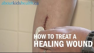 How to care for a healing wound  AboutKidsHealth at The Hospital for Sick Children [upl. by Rodd]