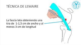 técnica de Lemaire [upl. by Ecaroh178]