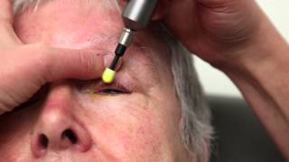 Blepharitis Treatment That Really Works Blephex Eyelid Cleaning [upl. by Hcir]