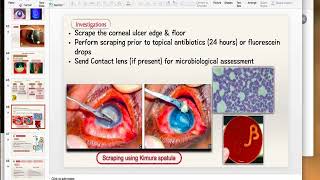 Bacterial Keratitis Part 2 [upl. by Jonny]