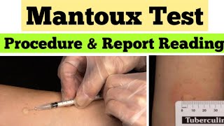 Mantoux Test in Hindi  Tuberculin Skin Test  mantoux test results reading [upl. by Iver]