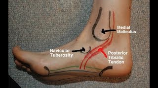 Posterior Tibial Tendinitis Evaluation with Paul Marquis PT [upl. by Karwan]