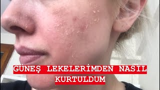 EYLÜL ÖZTÜRKGÜNEŞ LEKELERİMDEN NASIL KURTULDUMCİLTBAKIMI [upl. by Katharina]