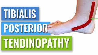 How to Get Rid of Posterior Tibial Tendonitis [upl. by Iht]