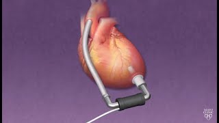 Mayo Clinic Minute How ventricular assist devices can help heart patients [upl. by Heathcote]