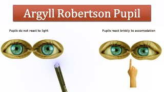 Argyll Robertson Pupil [upl. by Anaert]