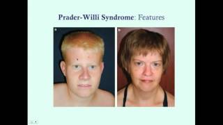 What are Treatment Options for PraderWilli Syndrome [upl. by Nuahsal]