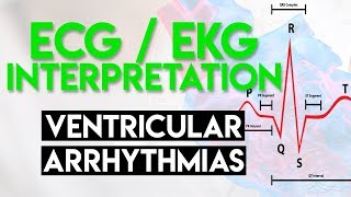 ECG Premature Ventricular Complexes PVC [upl. by Odanref]